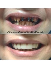 Dental Implants - Oris Dental Turkey