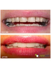 Smile Makeover - Ortodent Dental Clinic