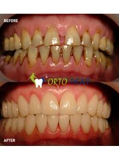 Full Mouth Rehabilitation - Ortodent Dental Clinic