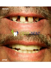 Dental Bridges - Ortodent Dental Clinic