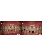 Gum Surgery - Ortodent Dental Clinic