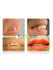 All-on-6 Dental Implants - Ortodent Dental Clinic