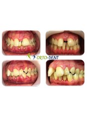 Periodontitis Treatment - Ortodent Dental Clinic