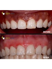 Gum Depigmentation - Ortodent Dental Clinic