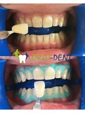 Teeth Whitening - Ortodent Dental Clinic