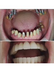 Dental Implants - Özel Hüseyin Yoldan Ağız ve Diş Sağlığı Polikliniği