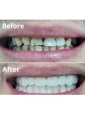 Zirconia Crown - Özel Hüseyin Yoldan Ağız ve Diş Sağlığı Polikliniği