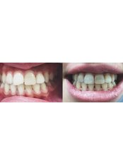 Fillings - Özel Hüseyin Yoldan Ağız ve Diş Sağlığı Polikliniği