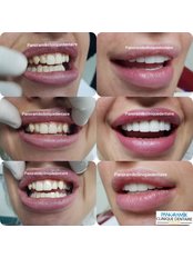 Dental Crowns - Panoramik  Dental Clinic Turkey