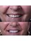 Safe Dent Dental Clinic -Dr Yesim Ramos - Metin kasapoglu cad Armada Apt no:44, Kat:2 D: 2-3, Antalya, 0700,  22