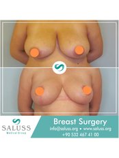 Breast Reduction - Saluss Medical Group
