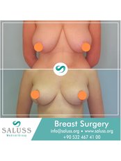 Breast Lift - Saluss Medical Group