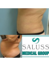 Tummy Tuck - Saluss Medical Group