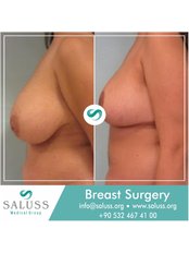 Breast Lift - Saluss Medical Group