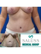 Mommy Makeover - Saluss Medical Group