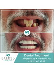 Dental Crowns - Saluss Medical Group