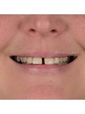 Zirconia Crown - Smilepod Dental Clinic