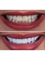 Teeth Whitening - Tantalya Dental Clinic