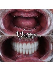 Dental Implants - UK - Turkey Health