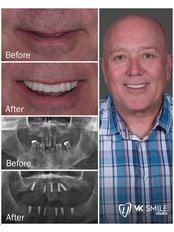 Immediate Implant Placement - VK Smile Dental Clinic