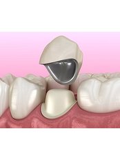Porcelain Fused To Metal Crown - VK Smile Dental Clinic