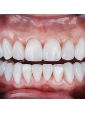 Dental Crowns - VK Smile Dental Clinic