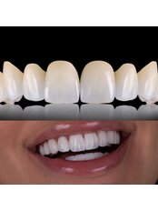 Zirconia Crown - VK Smile Dental Clinic