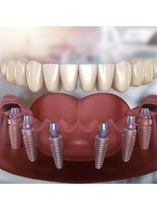 All-on-6 Dental Implants - VK Smile Dental Clinic