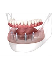 All-on-4 Dental Implants - VK Smile Dental Clinic