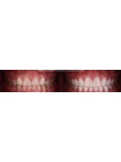 Veneers - Yalin Dental Clinic