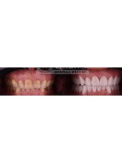 Zirconia Crown - Yalin Dental Clinic