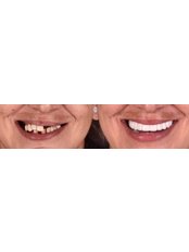 Dental Implants - Yalin Dental Clinic