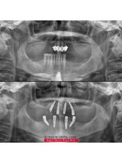 All-on-4 Dental Implants - Baron Dental Clinic / Dental Tourism Antalya