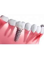 Single Implant - Dent Plaza Group