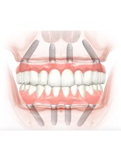 All-on-4 Dental Implants - Dent Plaza Group