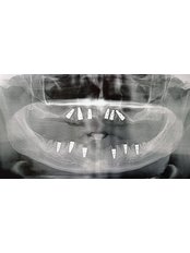 All-on-6 Dental Implants - Dent Plaza Group