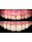 Side Dental Centre - Gingivektomi + Laminate Veneer = smile design 