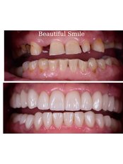 Dentist Consultation - Beautiful Smiles Antalya