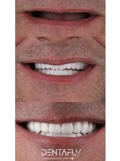 All-on-6 Dental Implants - Dentafly Dental Implant and Smile Studio