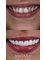 Dentafly Dental Implant and Smile Studio - Smile Makeover with Zirconia Crowns 1 