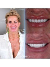 Lumineers™ - Dentafly Dental Implant and Smile Studio