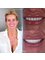 Dentafly Dental Implant and Smile Studio - EMAX® Laminate Veneers 