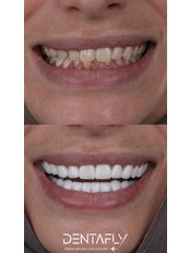 Veneers - Dentafly Dental Implant and Smile Studio