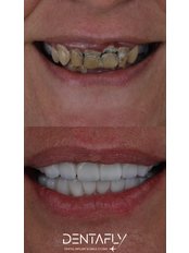 Smile Makeover - Dentafly Dental Implant and Smile Studio