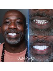 Gold Crown - Dentafly Dental Implant and Smile Studio