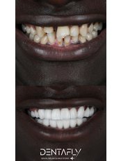 Hollywood Smile - Dentafly Dental Implant and Smile Studio