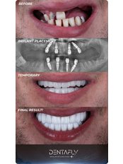All-on-4 Dental Implants - Dentafly Dental Implant and Smile Studio