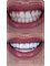 Dentafly Dental Implant and Smile Studio - EMAX® Full Veneers 