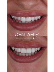 Composite Veneers - Dentafly Dental Implant and Smile Studio