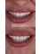 Dentafly Dental Implant and Smile Studio - COMPOSITE BONDING 